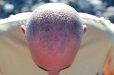 solar burns on the male head clipart