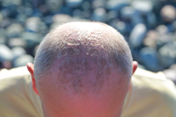 男性の頭の上の太陽の火傷 — ストック写真