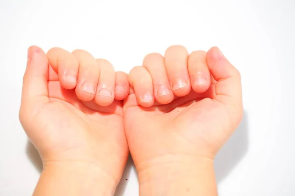 Onychophagia Gebeten Nagels Een Kind — Stockfoto