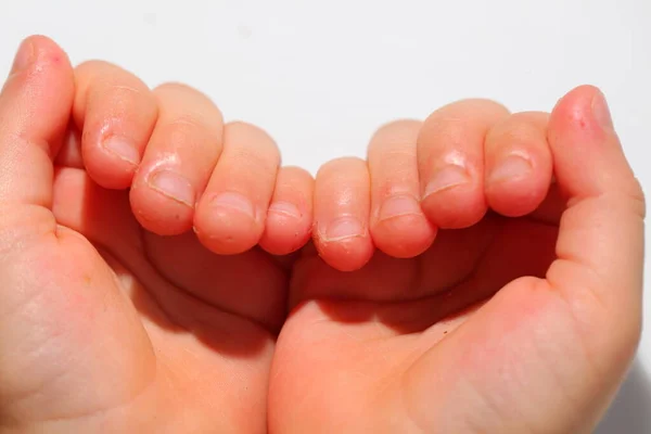 Onychophagia Bitten Nails Child — Stock Photo, Image