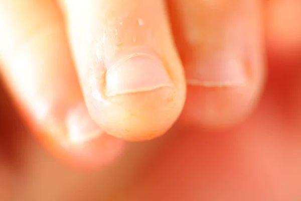 Onicofagia Unhas Mordidas Uma Criança — Fotografia de Stock