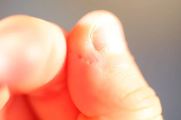Онихофагия Укушенные Ногти Ребенке — стоковое фото