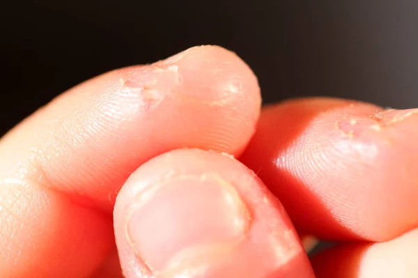 Onicofagia Unhas Mordidas Uma Criança — Fotografia de Stock