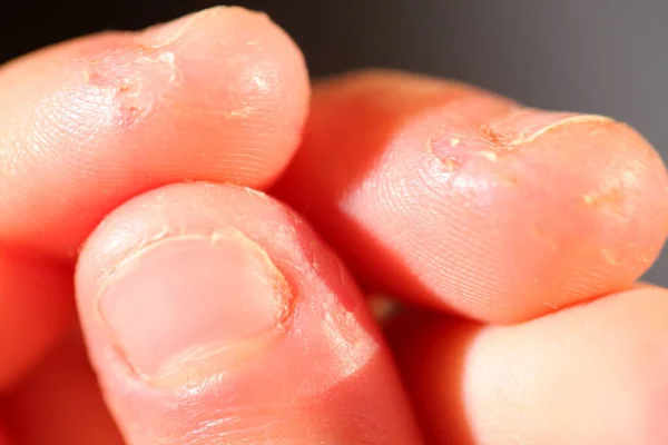 Onicofagia Unhas Mordidas Uma Criança — Fotografia de Stock