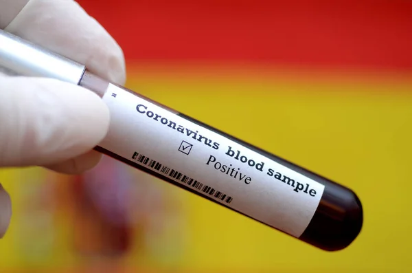 Coronavirus 2019 Ncov Kan Örneği Salgın Virüsü Solunum Sendromu Sendromu — Stok fotoğraf