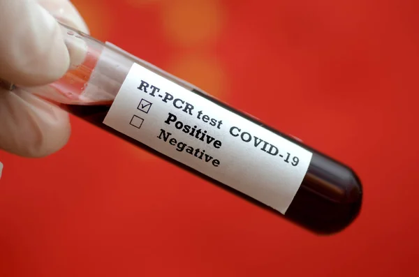 Coronavirus 2019 Ncov血液样本 流行病病毒呼吸综合征库存照片 科罗纳病毒在中国爆发 带血液检测的留置管存留照片 新型的Coronavirus 2019病 Covid Ncov 图库图片