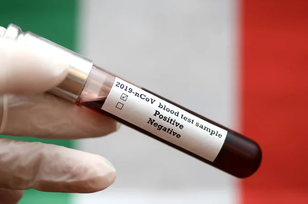 Коронавірус 2019 Ncov Зразок Крові Епідемічний Вірус Респіраторний Синдром Фото — стокове фото