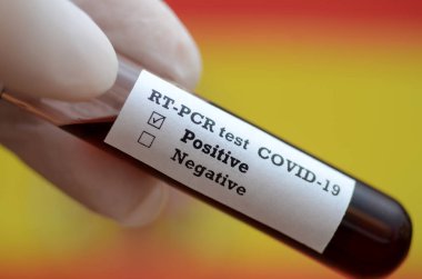Coronavirus 2019 nCoV kan örneği. Salgın virüsü Solunum Sendromu Sendromu fotoğrafı .