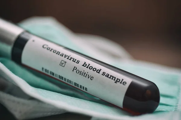 Coronavirus 2019 Ncov Kan Örneği Salgın Virüsü Solunum Sendromu Fotoğrafı — Stok fotoğraf