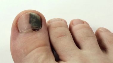 Mantar enfeksiyonu ile ayak tırnaklarını