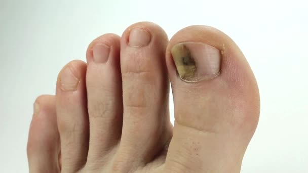 Toenails with fungal infection — Stock Video