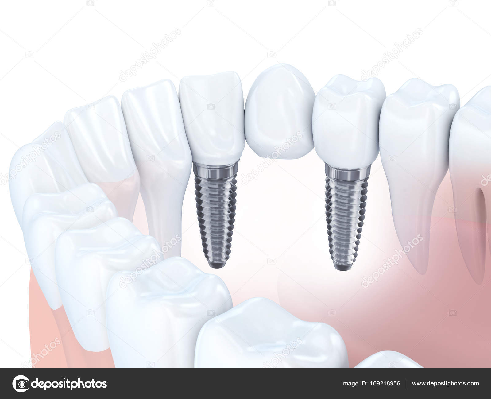 Dental implant bridge Stock Photo by ©Vladru 169218956