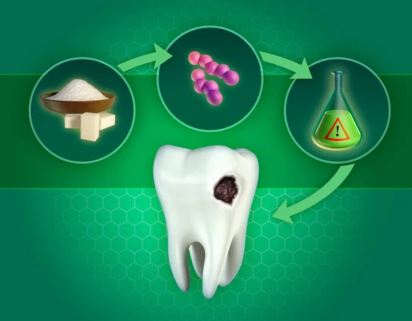 Bildung von Zahnhöhlen — Stockfoto