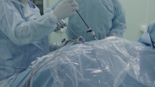 Cirugía laparoscópica del abdomen — Vídeos de Stock