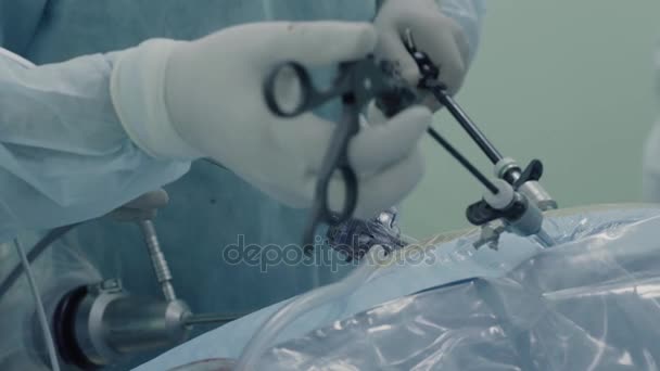 Laparoskopische Chirurgie des Bauches — Stockvideo