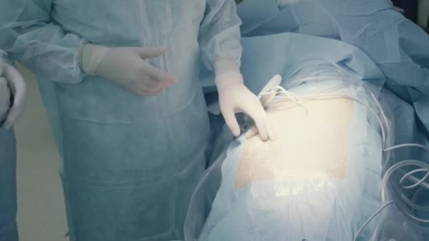 Antes de la cirugía laparoscópica del abdomen — Vídeo de stock