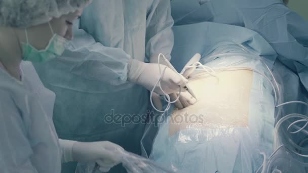 Avant la chirurgie laparoscopique de l'abdomen — Video