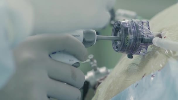 Cirurgia laparoscópica do abdômen — Vídeo de Stock