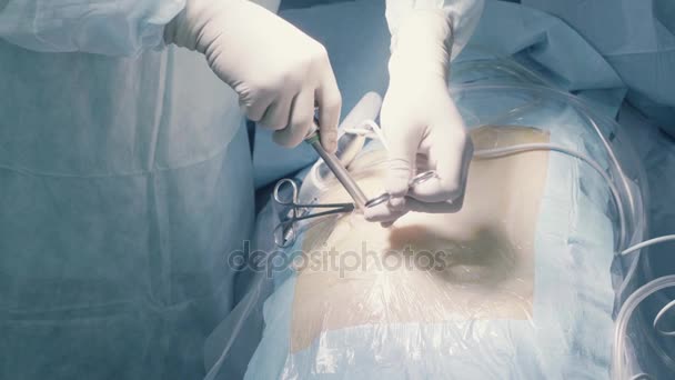 Beginning of laparoscopic of the abdomen — Stock Video