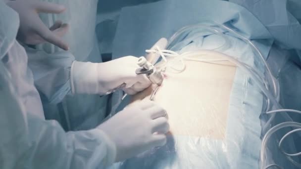 Beginning of laparoscopic of the abdomen — Stock Video