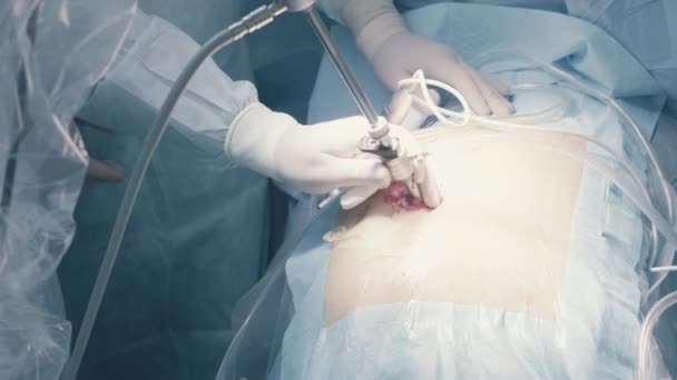 Laparoscopische chirurgie van de buik — Stockvideo