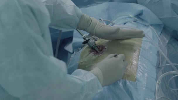 Laparoscopische chirurgie van de buik — Stockvideo