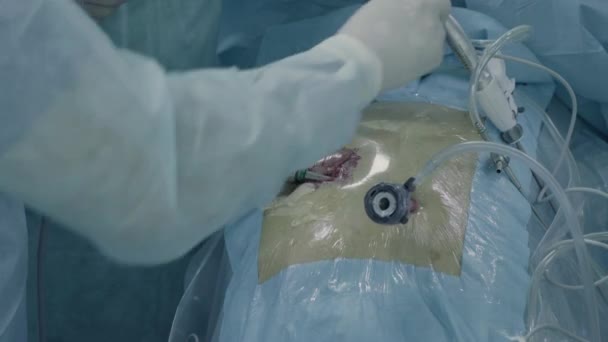 Laparoskopische Chirurgie des Bauches — Stockvideo