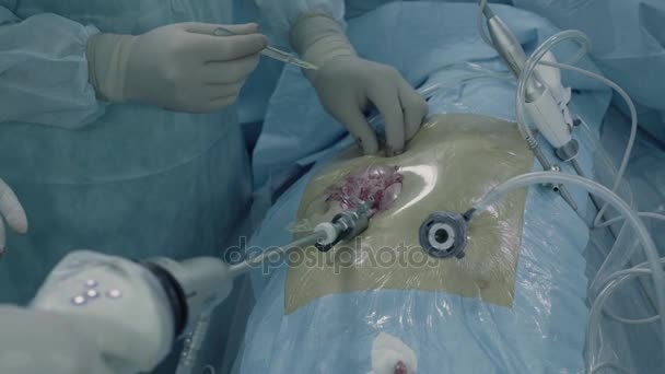 Laparoskopische Chirurgie des Bauches — Stockvideo