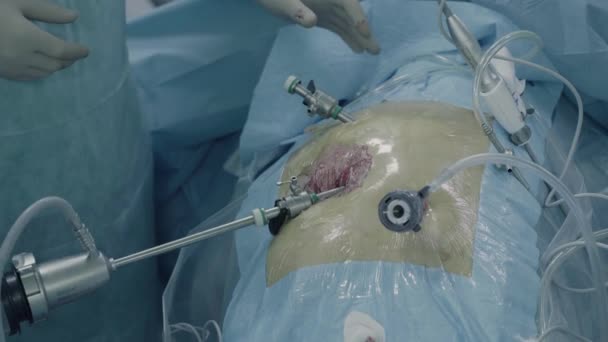 Cirugía laparoscópica del abdomen — Vídeos de Stock