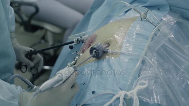 Laparoskopische Chirurgie des Bauches — Stockvideo