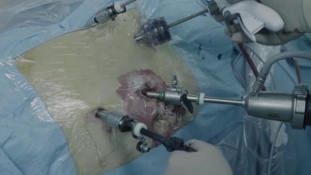 Laparoskopowa Chirurgia jamy brzusznej — Wideo stockowe