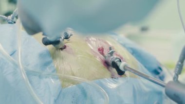 Laparoskopik cerrahi karın