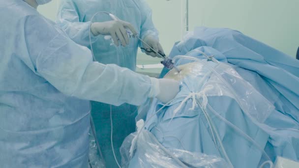 Лапароскопическая хирургия брюшной полости — стоковое видео