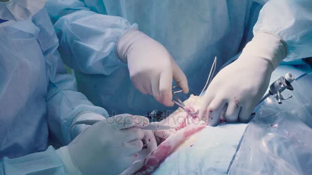 Surgical operation of the abdomen — Stock Video