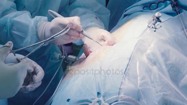 Cirugía laparoscópica del abdomen — Vídeo de stock