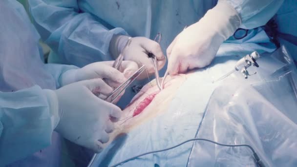 Chirurgische Operation des Bauches. Nähte — Stockvideo