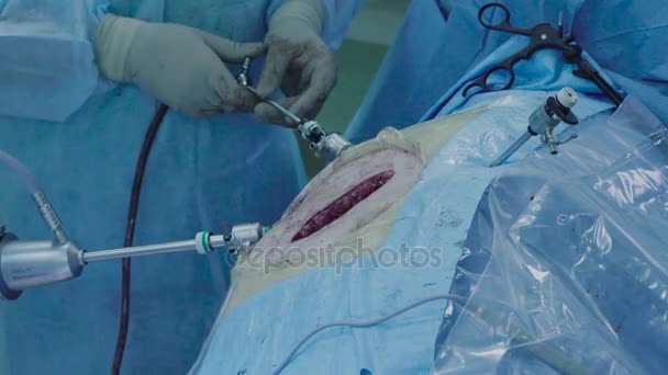 Laparoscopic surgery of the abdomen — Stock Video