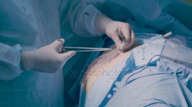 Cerrahi operasyon karın. Dikiş