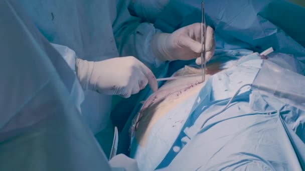 Surgical operation of the abdomen. Suturing — Stock Video