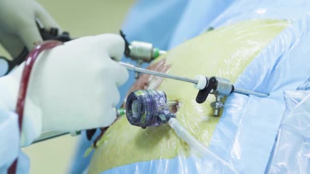 Buken av patienten under laparoskopisk operation — Stockvideo