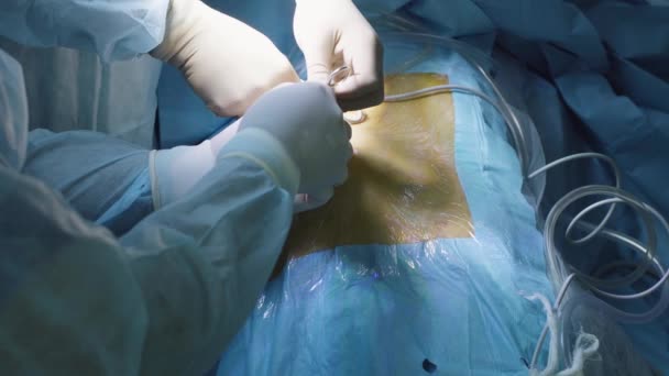 Handen van twee chirurg laparoscope invoegen — Stockvideo