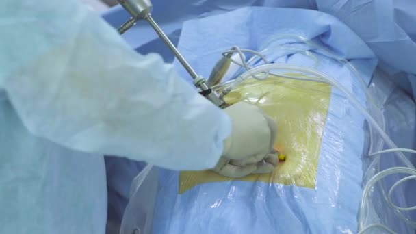 Руки хирурга, вставляющего инструмент — стоковое видео