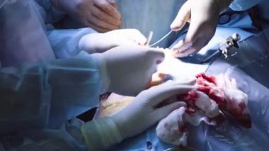 Karın bölgesinde bir kesi yaparak cerrah