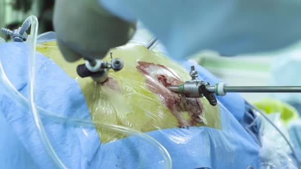 Buik van de patiënt tijdens de laparoscopische operatie — Stockvideo
