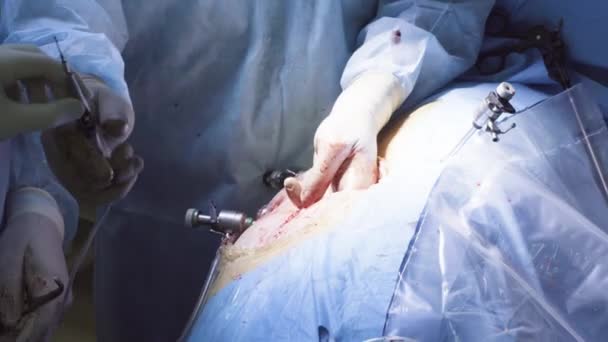 The surgeon making an incision on the abdomen — Stock Video