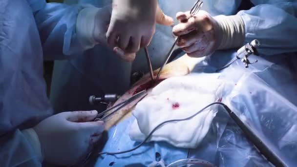 Руки двух хирургов во время швов — стоковое видео