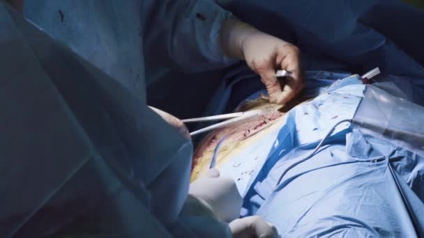 Mains des deux chirurgiens pendant la suture — Video
