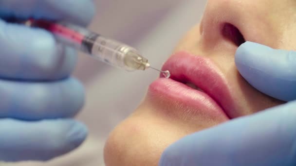 Gesicht des Patienten während der Lippenvergrößerung — Stockvideo