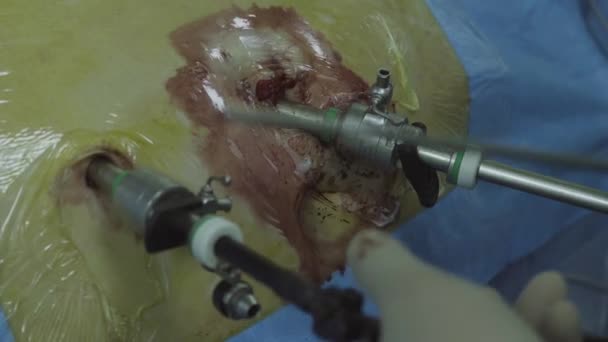 Bauch des Patienten während der laparoskopischen Operation — Stockvideo