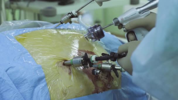Живот пациента во время лапароскопической операции — стоковое видео